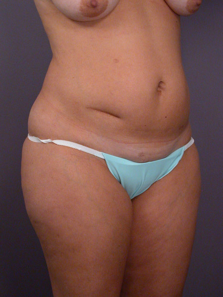 Liposuction before and after photo