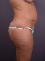 Liposuction Before and after photo