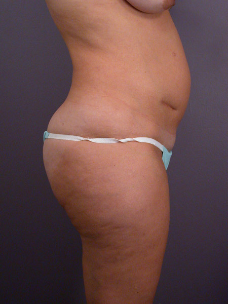 Liposuction before and after photo