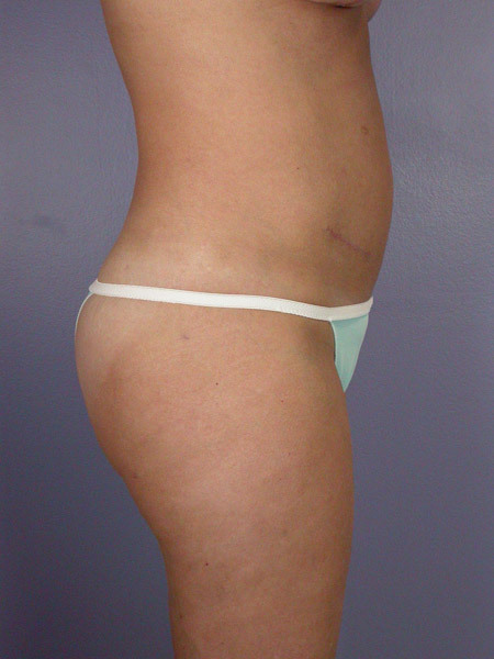 Liposuction before and after photo