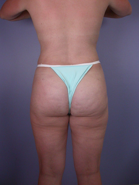 Liposuction before and after photo