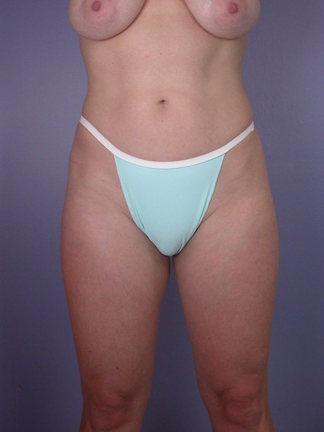 Liposuction before and after photo