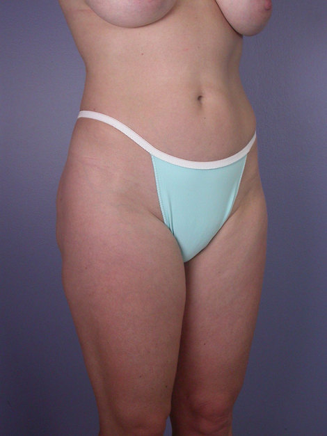 Liposuction before and after photo