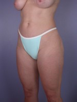 Liposuction Before and after photo