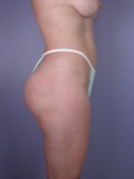 Liposuction Before and after photo