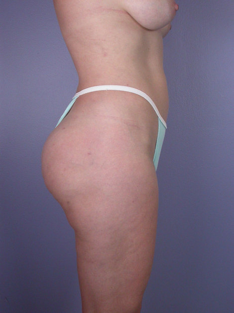 Liposuction before and after photo