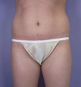 Liposuction before and after photo