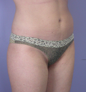 Liposuction before and after photo