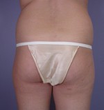 Liposuction Before and after photo