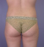 Liposuction Before and after photo