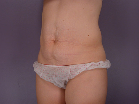 Liposuction before and after photo