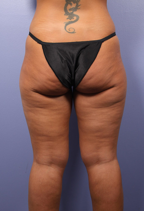 Liposuction before and after photo