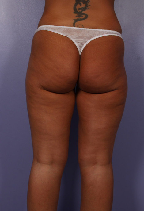 Liposuction before and after photo