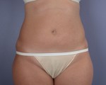 Liposuction