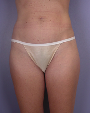 Liposuction before and after photo