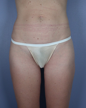 Liposuction before and after photo