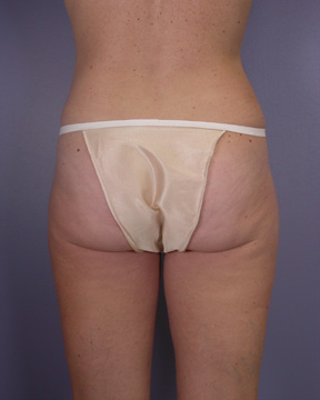 Liposuction before and after photo