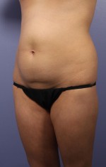 Liposuction Before and after photo