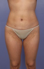 Liposuction