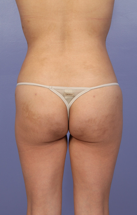 Liposuction before and after photo