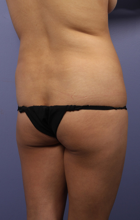 Liposuction before and after photo