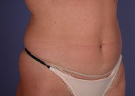 Liposuction before and after photo