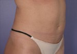 Liposuction