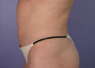 Liposuction before and after photo