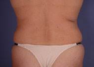 Liposuction before and after photo