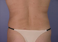 Liposuction before and after photo