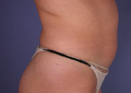 Liposuction before and after photo