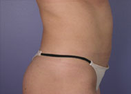 Liposuction before and after photo