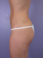 Liposuction Before and after photo