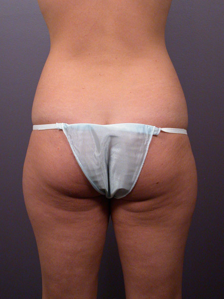 Liposuction before and after photo