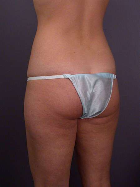 Liposuction before and after photo