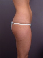 Liposuction Before and after photo