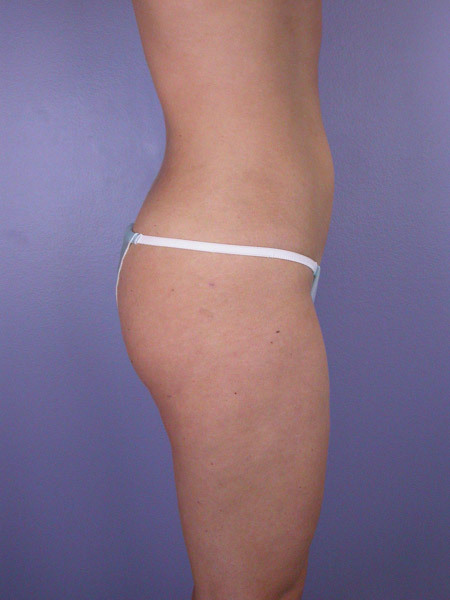 Liposuction before and after photo