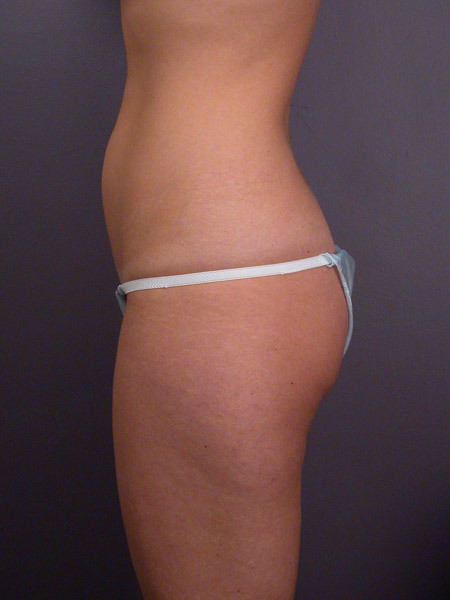 Liposuction before and after photo