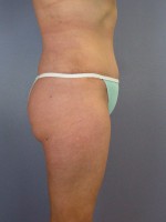 Liposuction Before and after photo