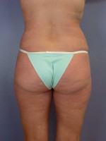 Liposuction Before and after photo