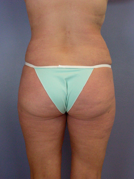 Liposuction before and after photo