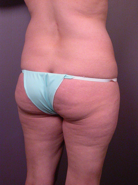 Liposuction before and after photo