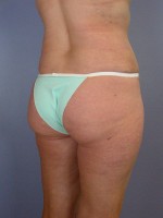 Liposuction Before and after photo