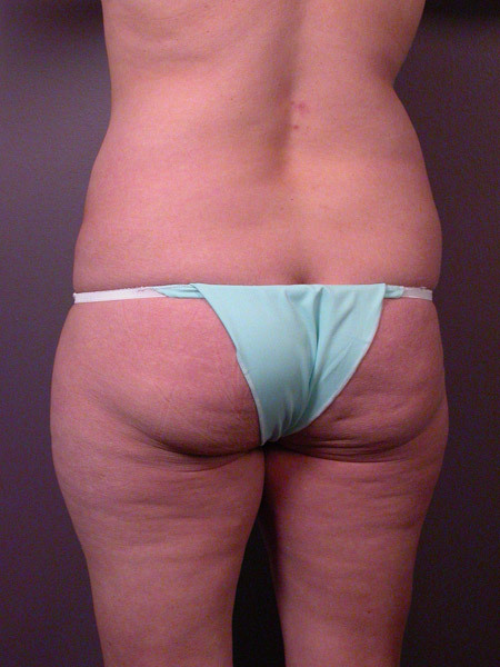 Liposuction before and after photo