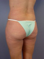 Liposuction Before and after photo