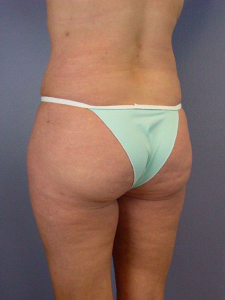 Liposuction before and after photo