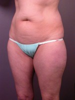 Liposuction Before and after photo