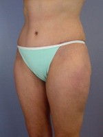 Liposuction Before and after photo