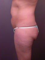 Liposuction Before and after photo