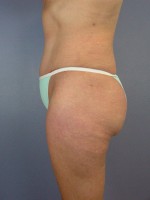 Liposuction Before and after photo